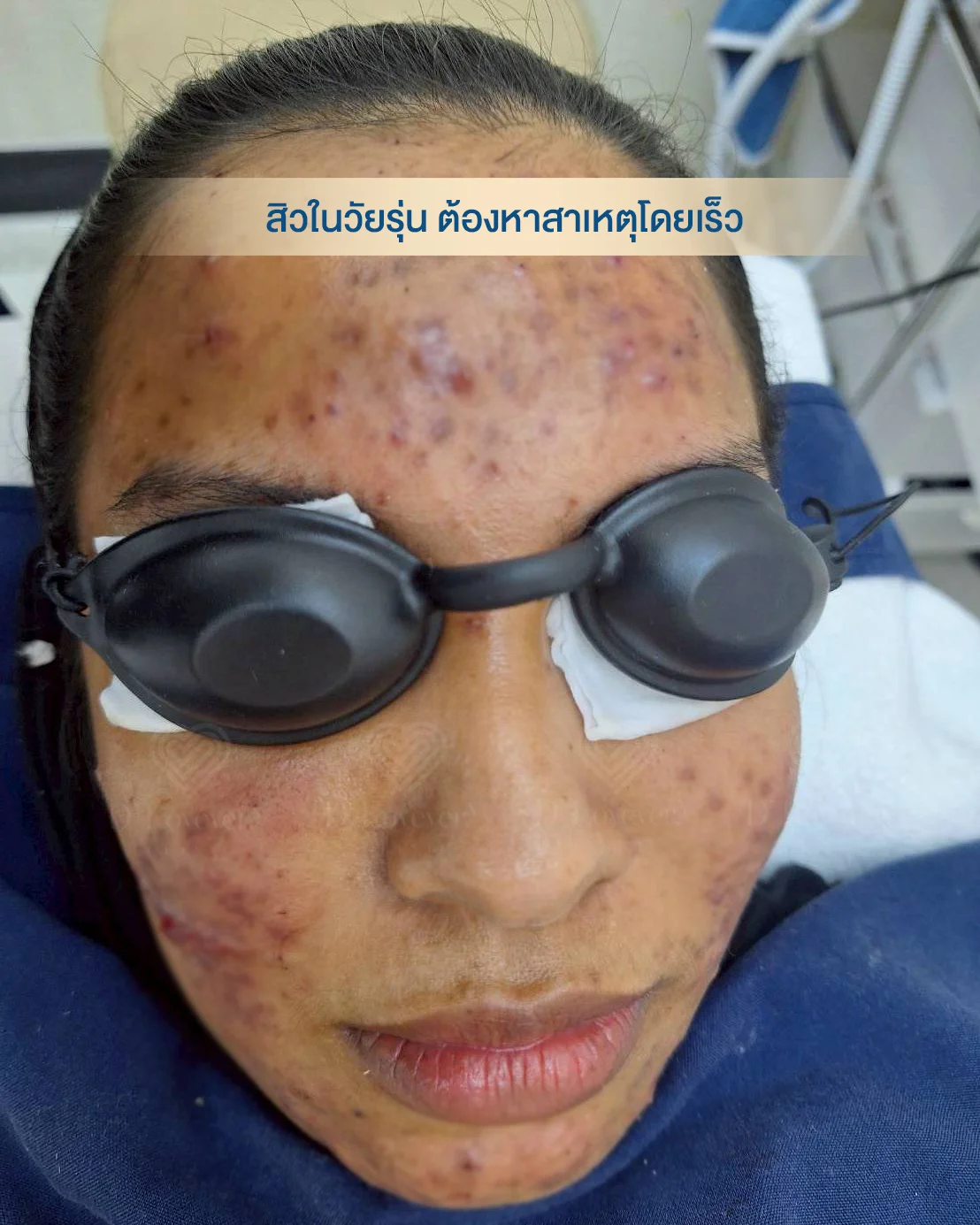 คลินิกรักษาสิว สิวไต ยาสิว