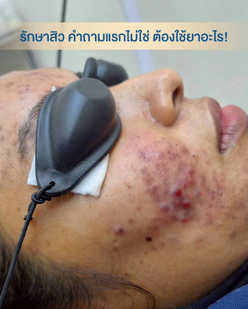 คลินิกรักษาสิว สิวไต ยาสิว