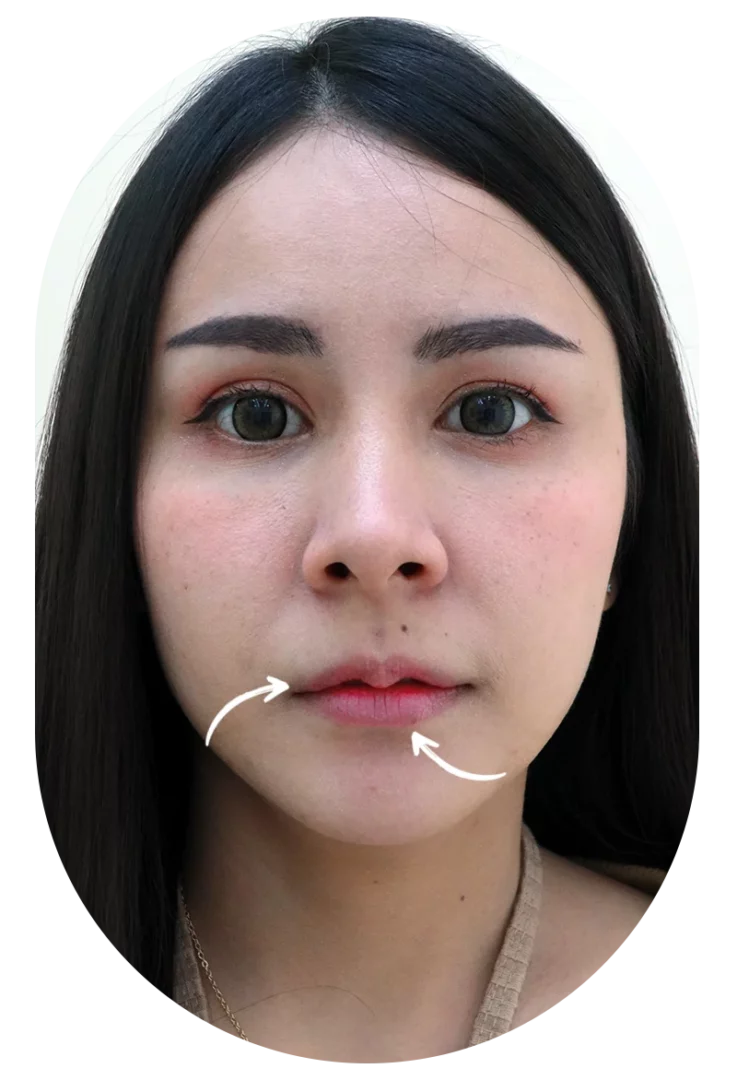 Thin Lips Case115 Before Filler Dlovevery Clinic
