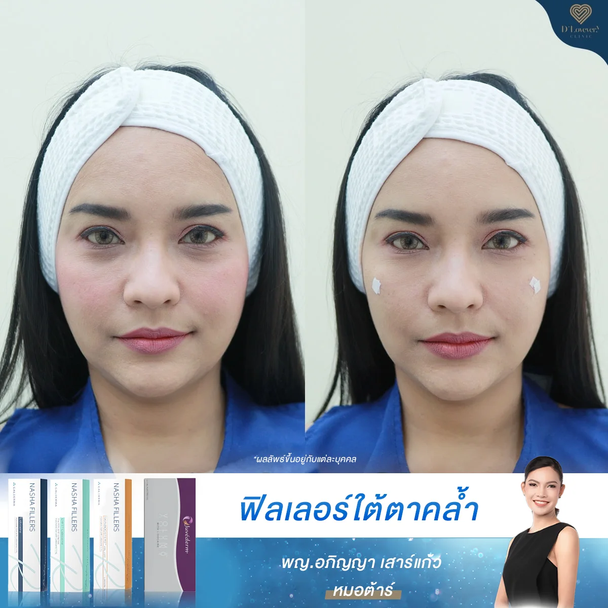 รีวิวฉีดฟิลเลอร์ใต้ตา ย่านเลียบด่วน-รามอินทรา โปรแรง ผ่อนสบาย 0%