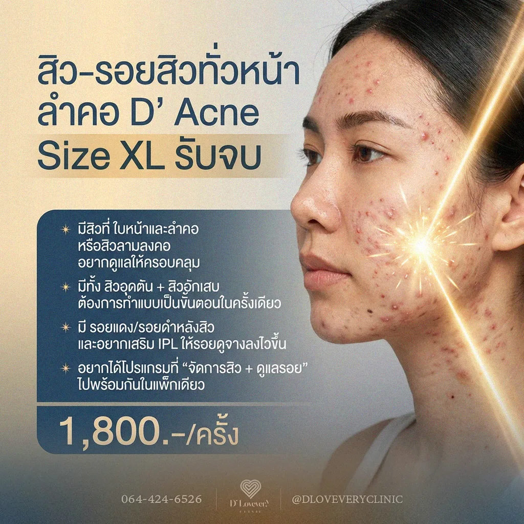 คอร์สรักษาสิวทั่วหน้า + ลำคอ + IPL ลดรอยทั่วบริเวณ D’ Acne XL ครบวงจรกว่ายังไง เหมาะกับใคร ราคาเท่าไหร่ คำถามที่พบบ่อย
