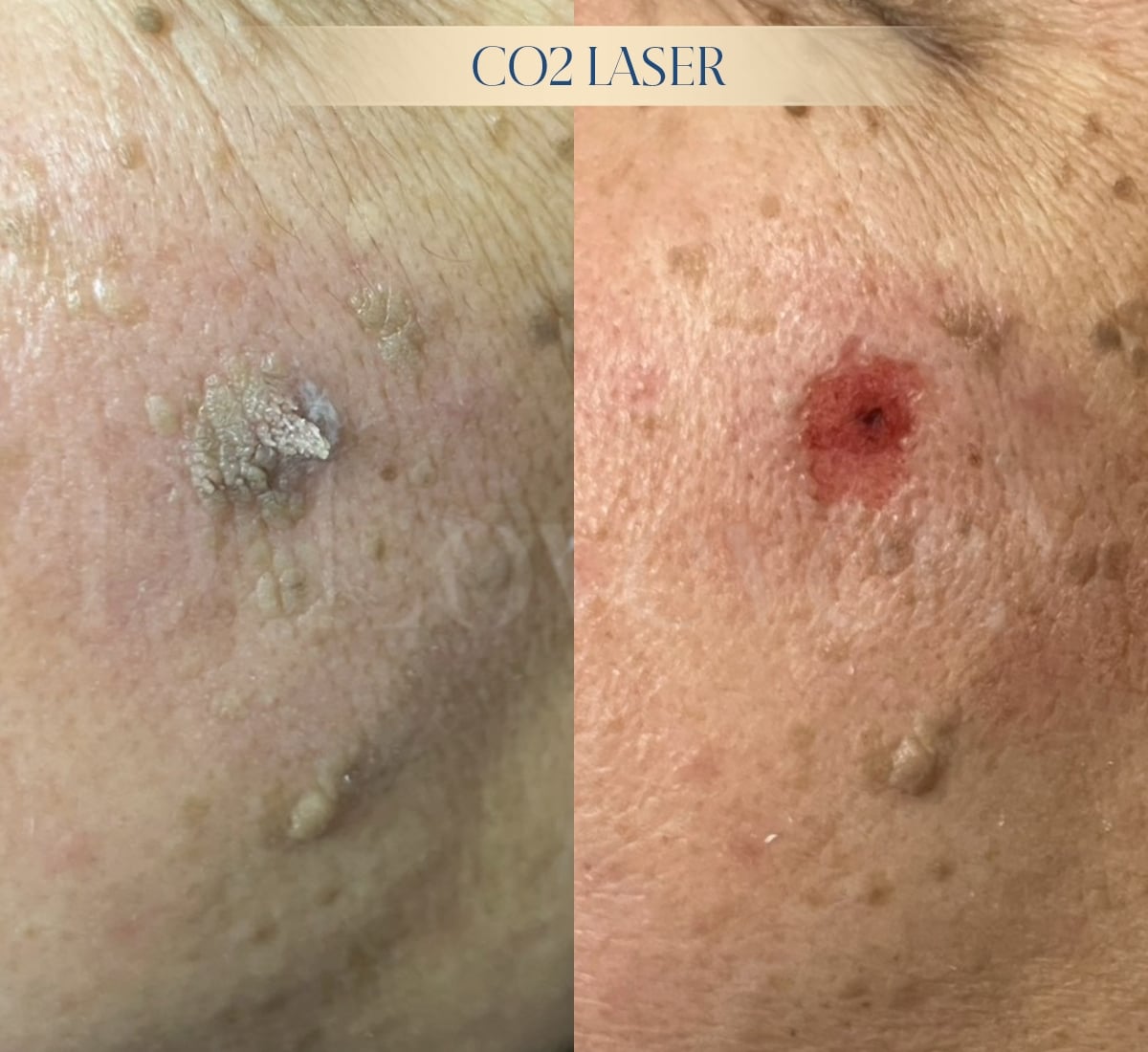 หูด กำจัดหูด ด้วย co2 laser ราคาเริ่มต้น 2500 บาท มีค่ายาทา 200