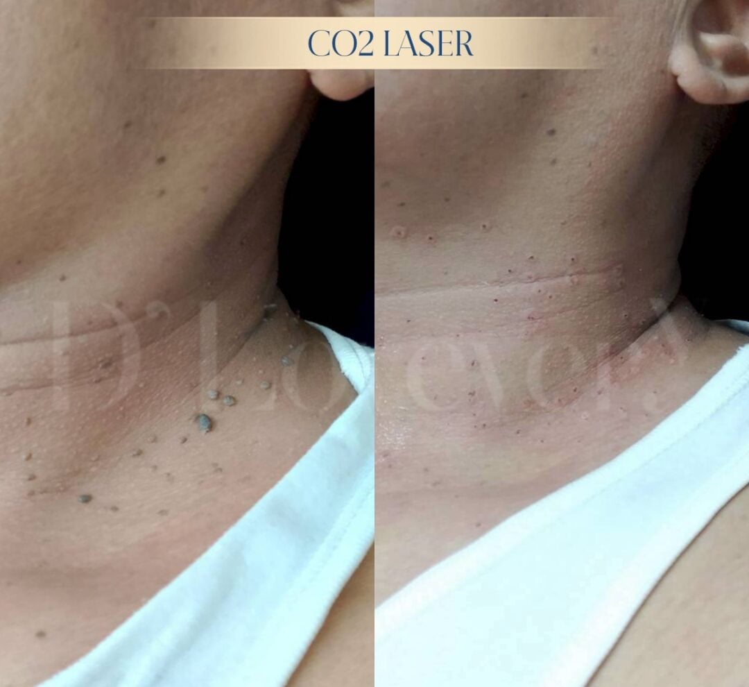 คลินิกจี้ติ่งเนื้อที่คอ รับบัตรเครดิต รับ Spaylater