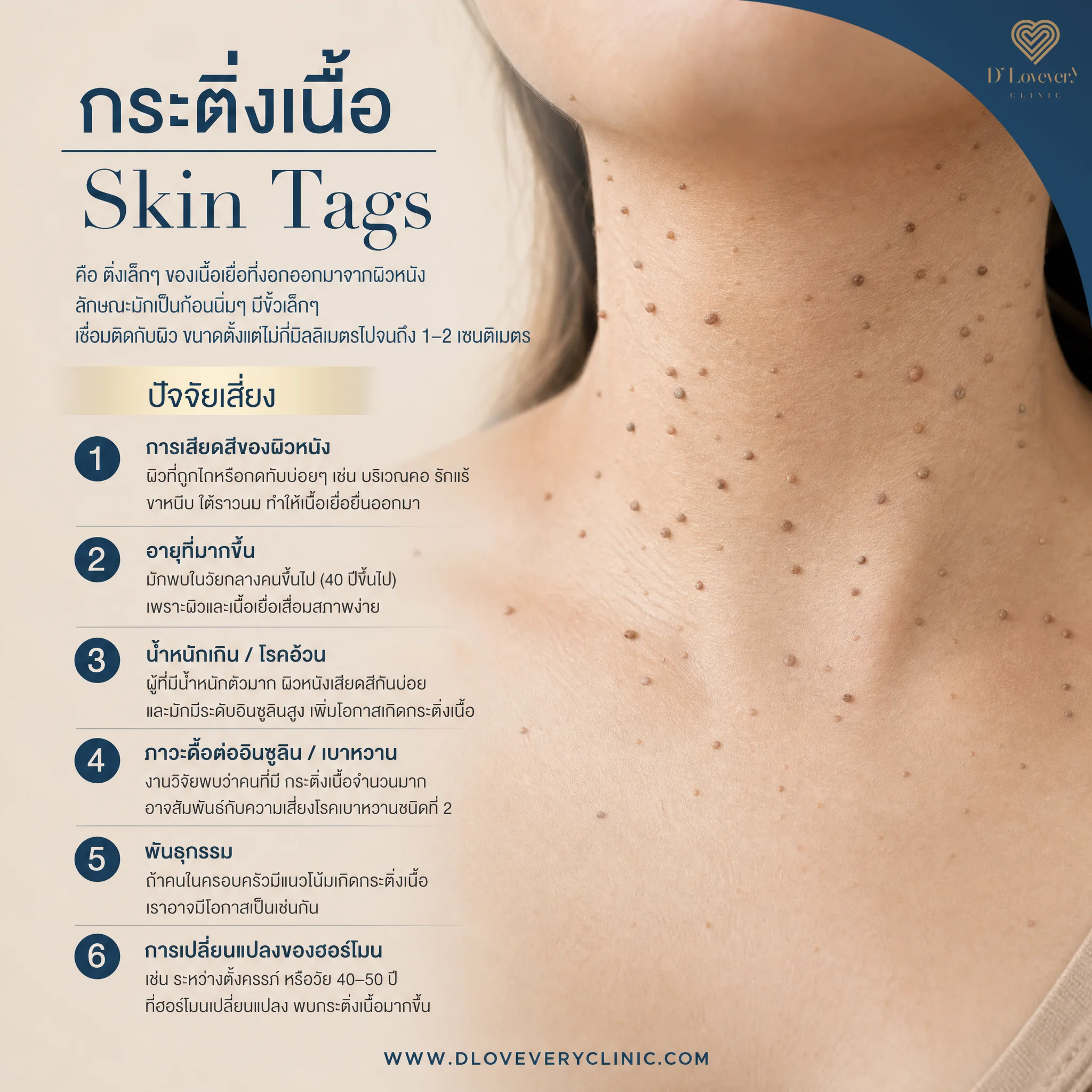 ติ่งเนื้อ กระเนื้อ skin tag