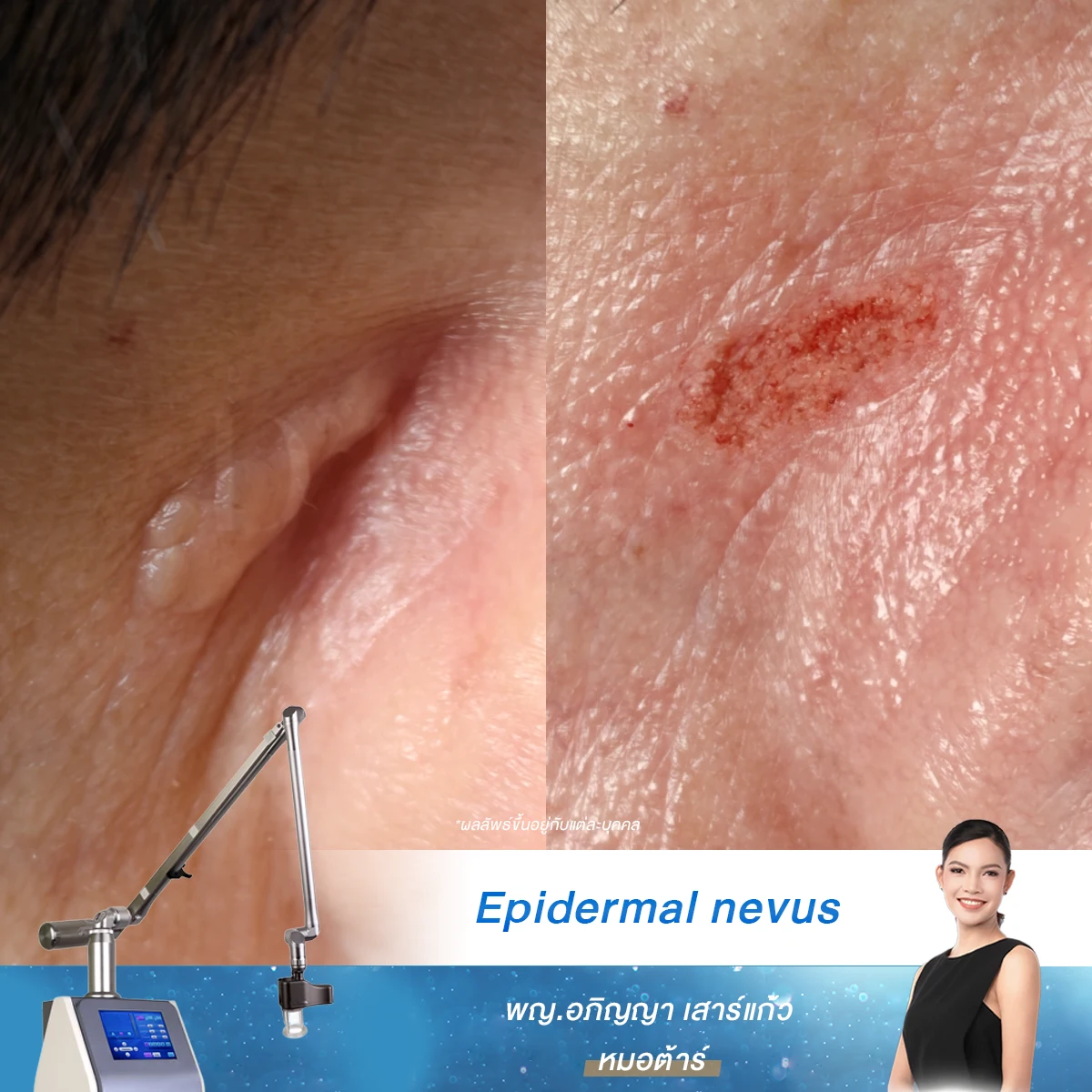 Epidermal nevus Epidermal nevus อันตรายไหม จี้ด้วย CO2 laser ได้ผลแค่ไหน รวมคำตอบจากแพทย์ความงาม เคลียร์ชัดเรื่องโอกาสเกิดซ้ำและการดูแลผิวให้เนียนสวยปลอดภัย