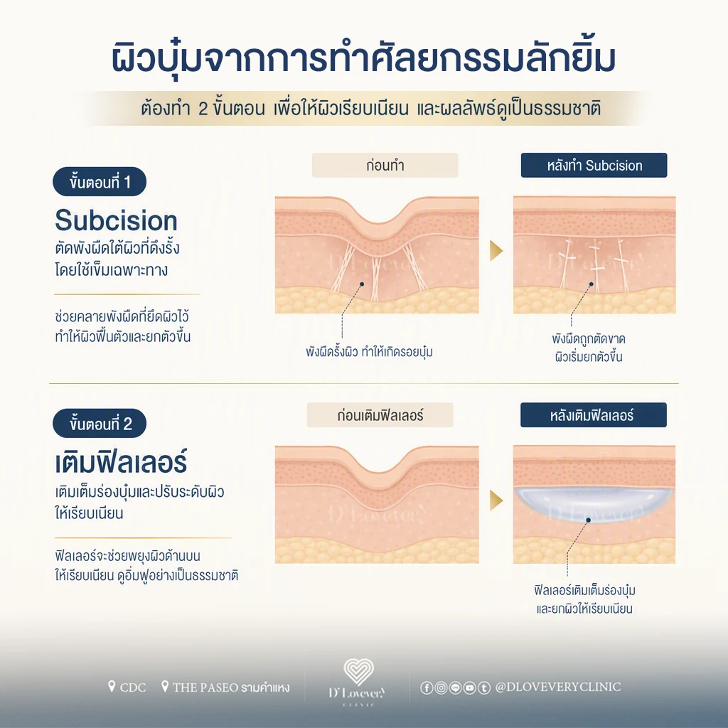 แก้ลักยิ้ม เติมฟิลเลอร์ลักยิ้ม ตัดพังผืด เติมเต็มด้วยฟิลเลอร์
