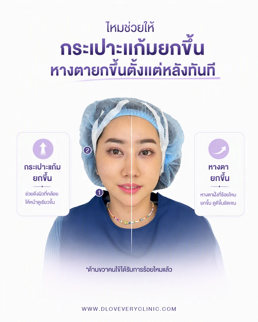 เป็นคนมีกระเปาะแก้ม แก้มห้อย แก้มหย่อนคล้อย ร้อยไหมช่วยได้แค่ไหน รีวิวร้อยไหม