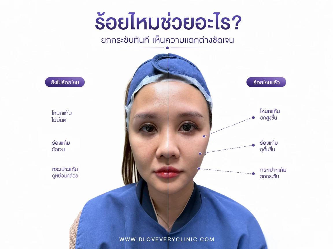 ร้อยไหม ช่วยเรื่องอะไร ทำให้หน้าดีขึ้นยังไงบ้าง ดีเลิฟเวอรี่คลินิก คลินิกร้อยไหม