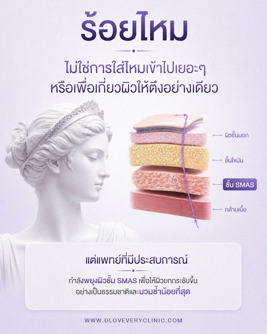 ร้อยไหม ร้อยถึงผิวชั้น SMAS ชั้นเดียวกันกับที่ศัลยแพทย์ใช้ทำการดึงหน้าผ่าตัด Face Lift Face Lock