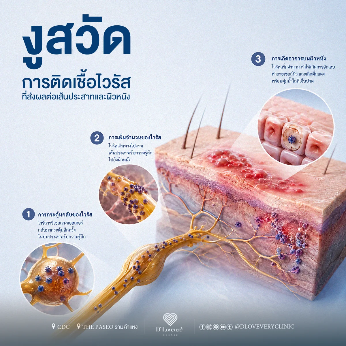 งูสวัด เกิดจากอะไร เชื้อแบบไหน รักษายังไง อาการเป็นอย่างไร