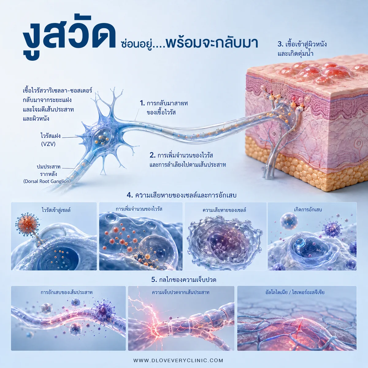 อาการของโรคงูสวัด ปวดแสบ ปวดร้อน ตามเส้นประสาท เกิดจากอะไร