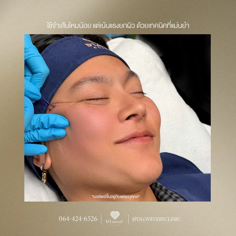 ไหม Licellvi ต้องใช้กี่เส้น ราคาเท่าไหร่ ดียังไง เหมาะกับปัญหาผิวหย่อนคล้อยแบบไหนบ้าง