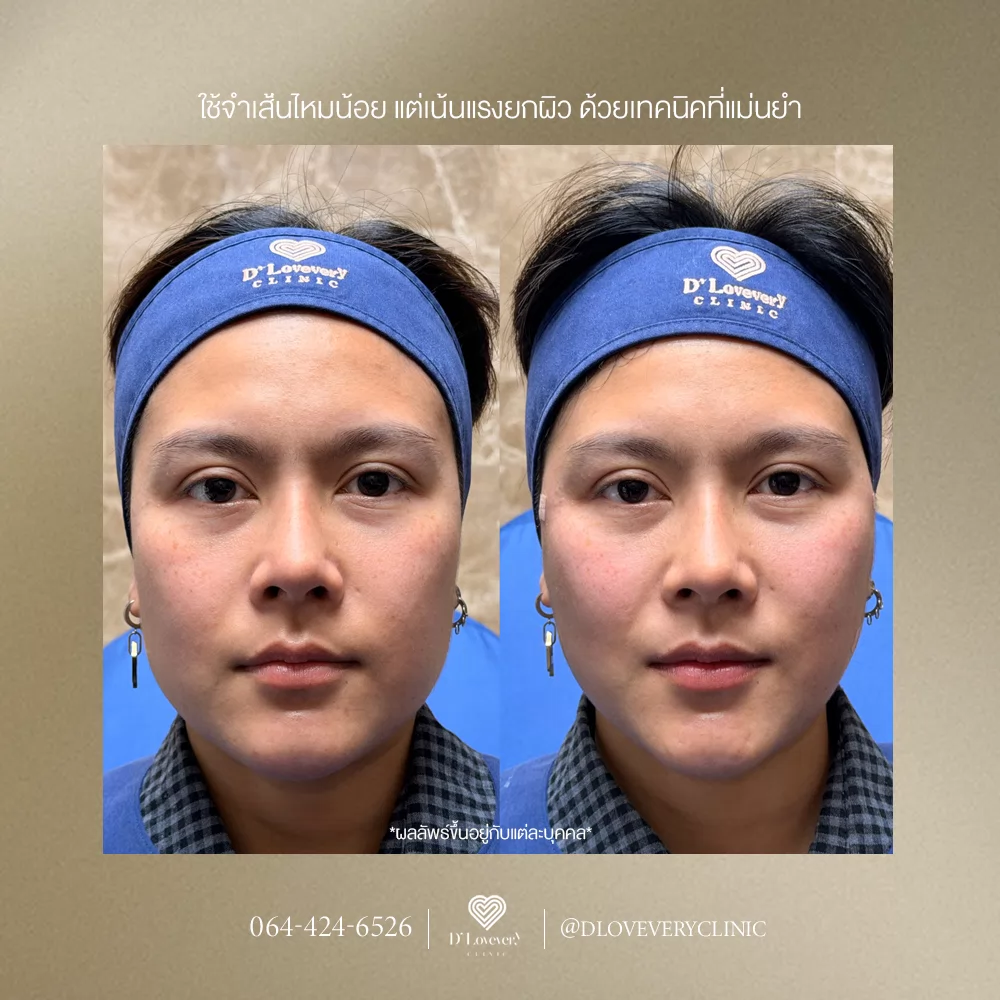 รีวิวไหม Licellvi ก่อนทำ หลังทำ ดียังไง ต้องใช้กี่เส้น เหมาะกับปัญหาผิวหย่อนคล้อยแบบไหนบ้าง